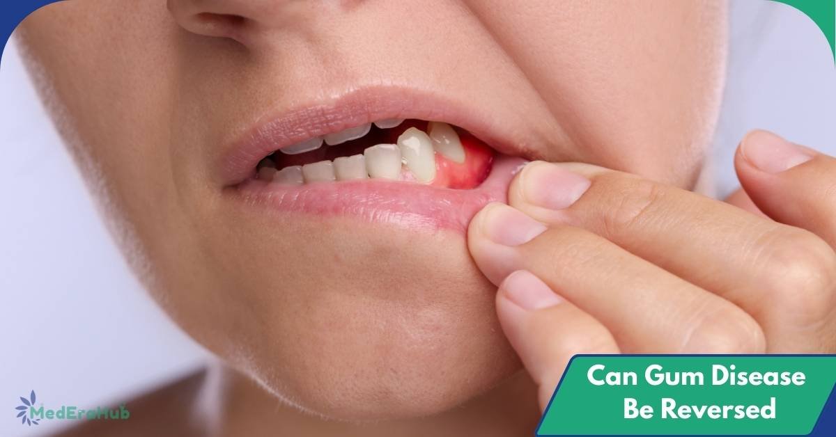 Can Gum Disease Be Reversed