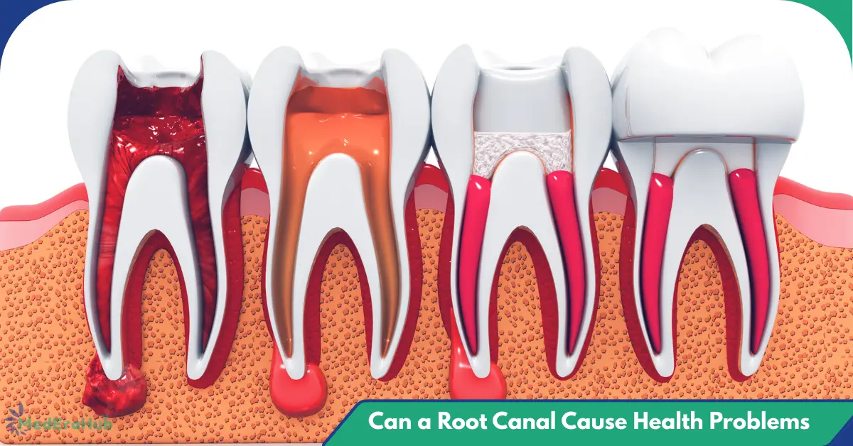Can a Root Canal Cause Health Problems