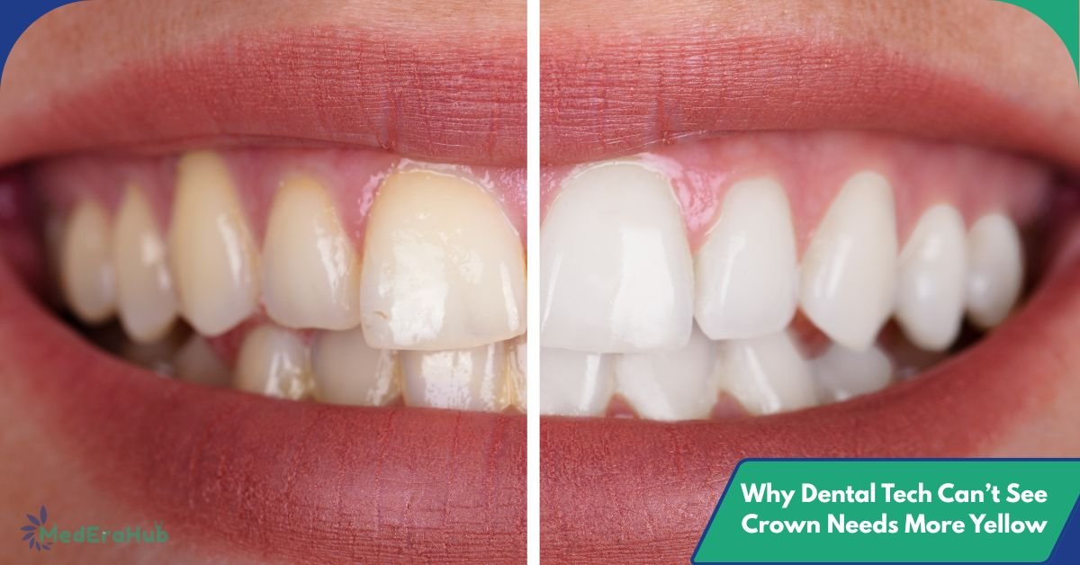 Why Dental Tech Can’t See Crown Needs More Yellow