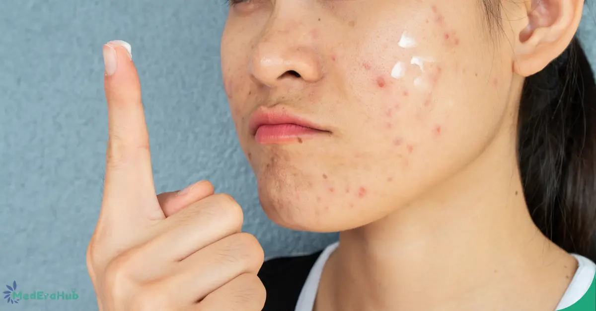 HydraFacial for Acne